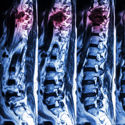 MRI image of spinal fracture